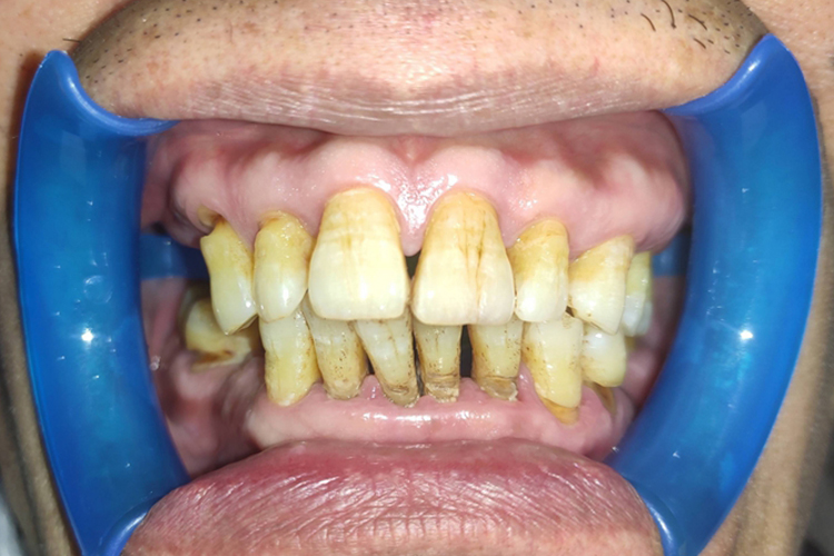 牙周炎牙周袋形成、牙齿松动图