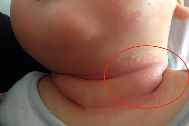 急性湿疹脖子红疹图