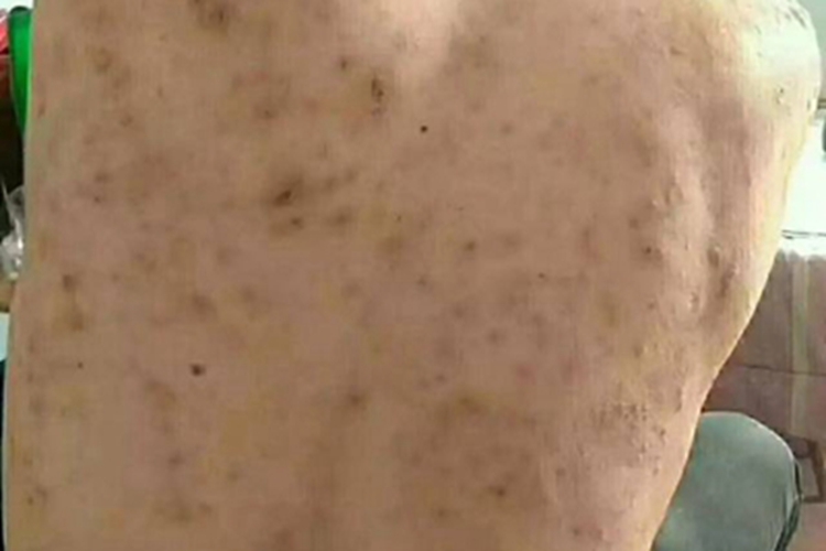 色素性痒疹背部有褐色点图 色素性痒疹背部有褐色点图