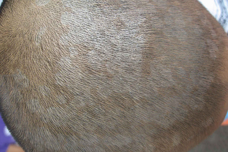 头皮花斑糠疹图