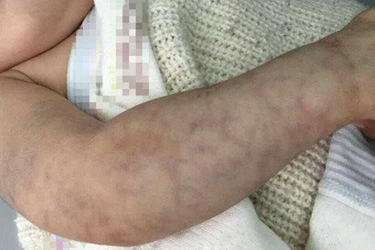 新生儿毛细血管扩张症图 新生儿毛细血管扩张症图