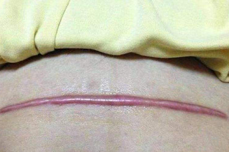 经腹子宫肌瘤手术疤痕图