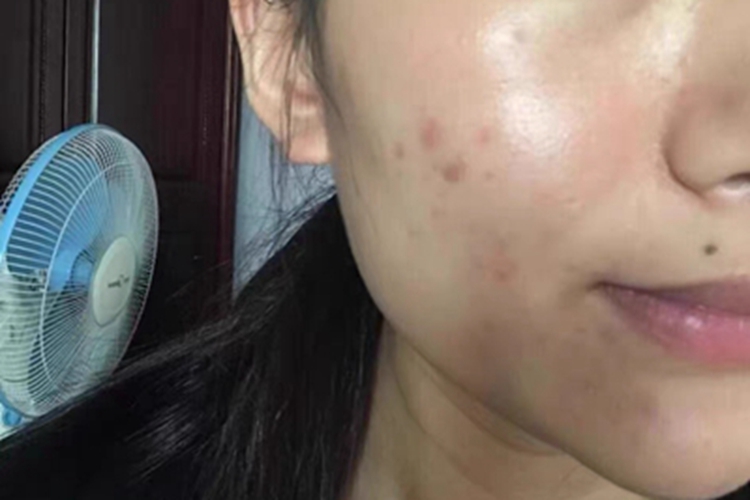 痤疮右脸有斑块图