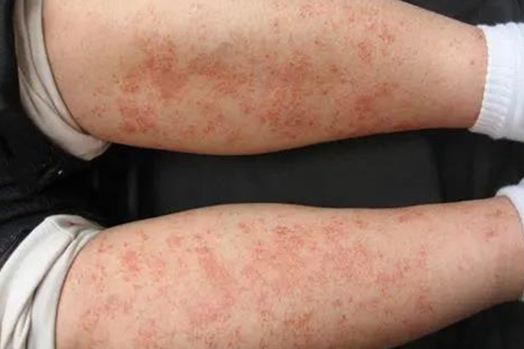 铁锈色苔藓样皮损图 铁锈色苔藓样皮损图