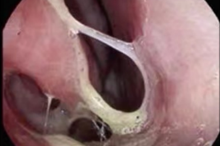 鼻硬结病鼻腔化脓图