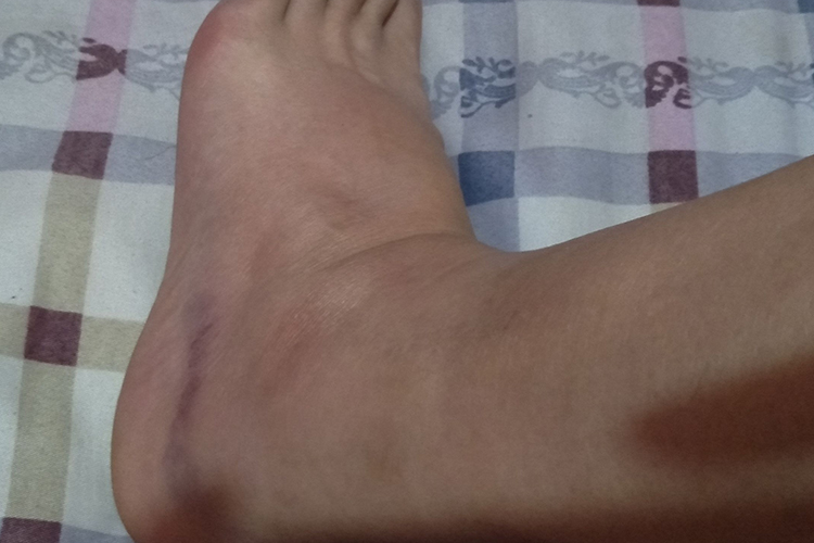 脚踝外伤脚踝外侧发黑图