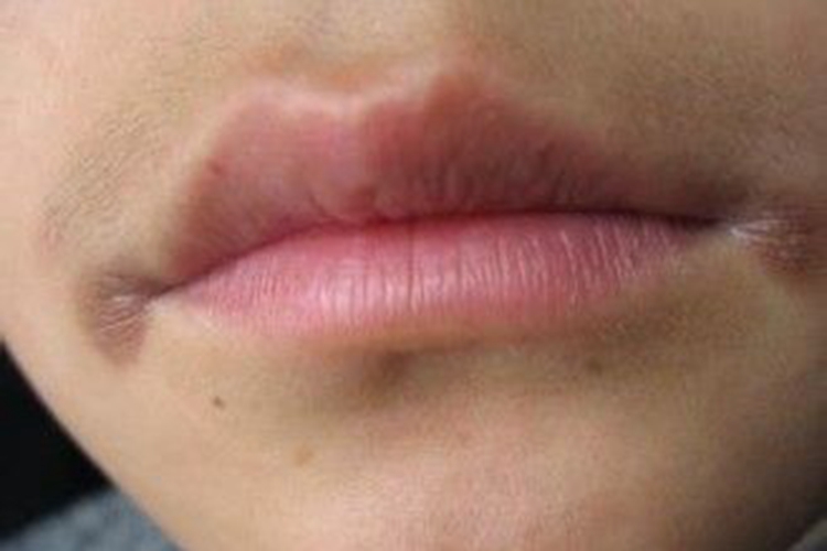 缺铁性贫血口周发黑图 缺铁性贫血口周发黑图