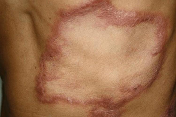 界限类偏结核样型麻风背部红斑图