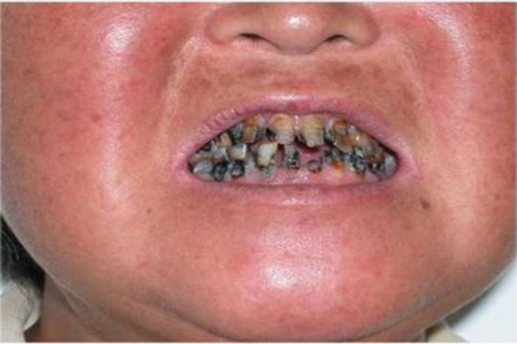 干燥综合征牙齿发黑图 干燥综合征牙齿发黑图
