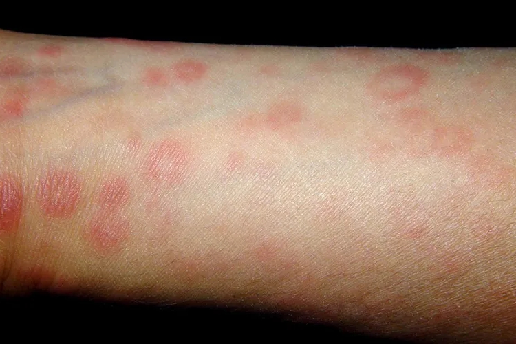 梅毒疹红色斑丘疹图 梅毒疹红色斑丘疹图