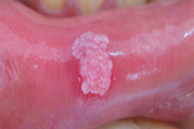 口腔尖锐湿疣唇内侧症状图