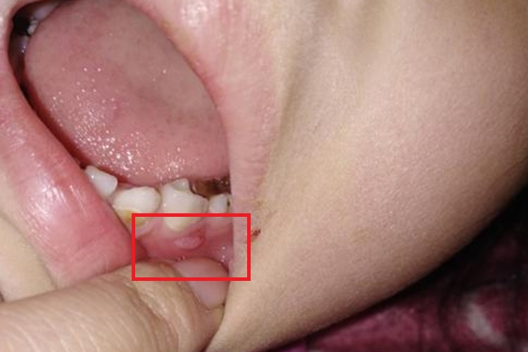 1岁宝宝慢性龈炎图