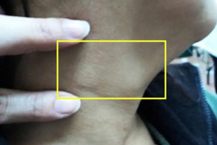 皮肤猪囊虫病颈部症状图