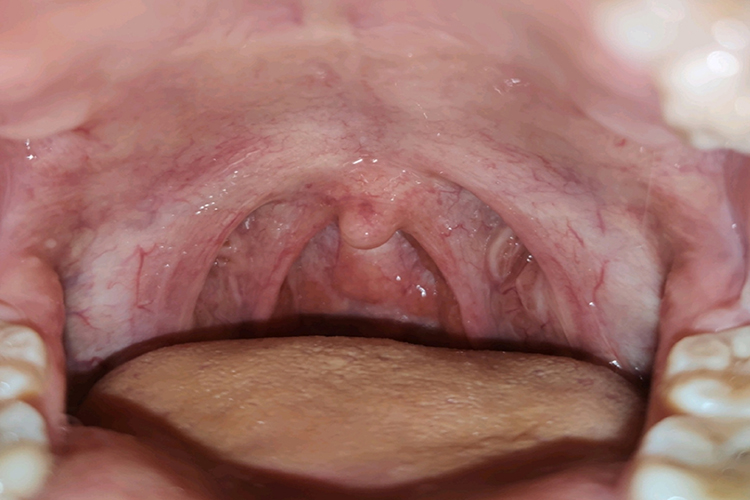 慢性单纯性咽炎淋巴增生图