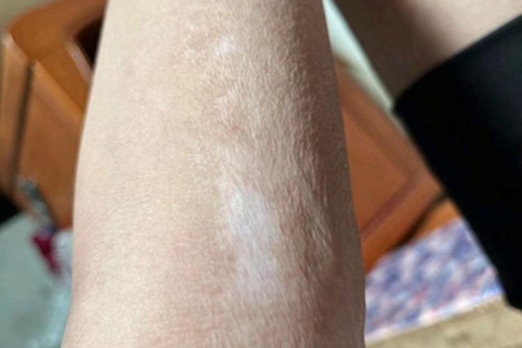 进展期节段型白癜风白斑图