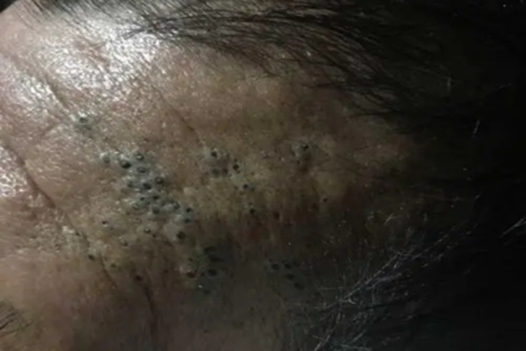 扩张孔前额症状图