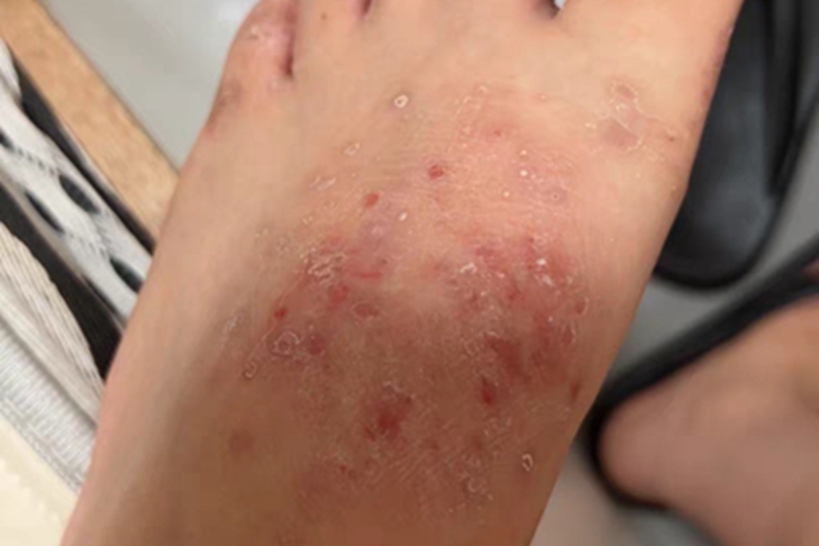 足癣脚背糜烂图 足癣脚背糜烂图