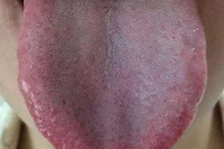 肝郁脾虚证舌头图