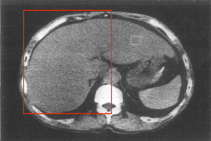 早期艾滋病肝大图
