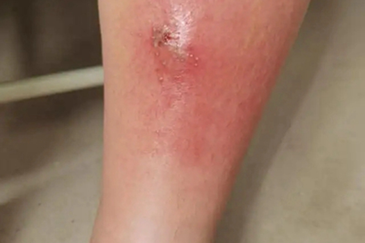 蜂窝织炎小腿发红图