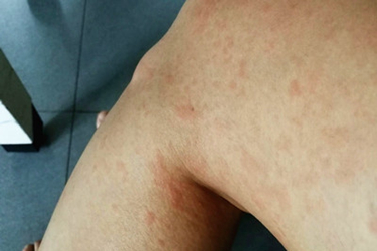 荨麻疹腿风团图 荨麻疹腿风团图