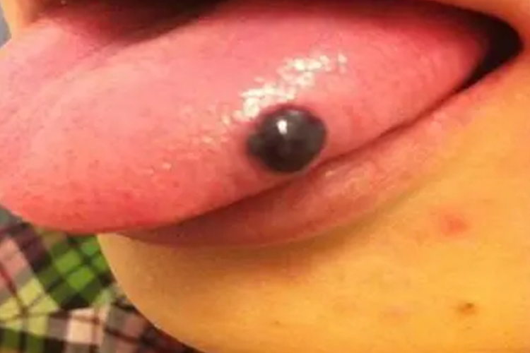 舌头上长黑血疱图