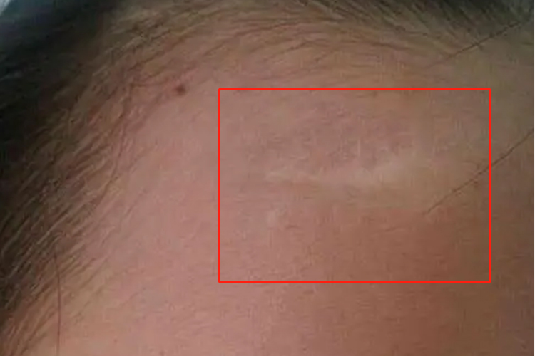 小孩缝针疤痕恢复一年图 小孩缝针疤痕恢复一年图