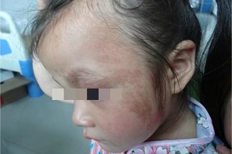 咖啡斑面部有棕色斑图 咖啡斑面部有棕色斑图