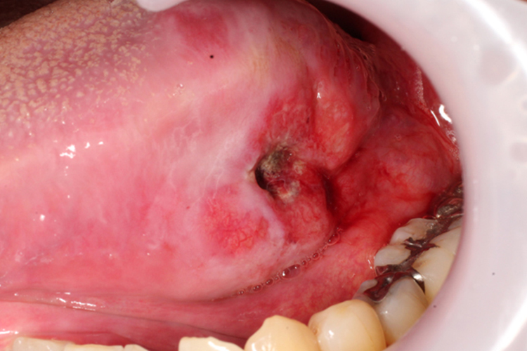 溃疡型舌癌图 溃疡型舌癌图