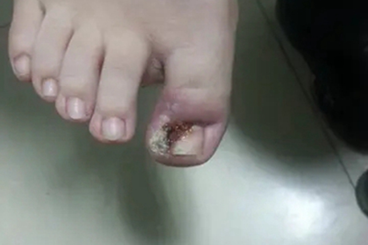 化脓性甲沟炎脚趾皮肤增厚图 化脓性甲沟炎脚趾皮肤增厚图