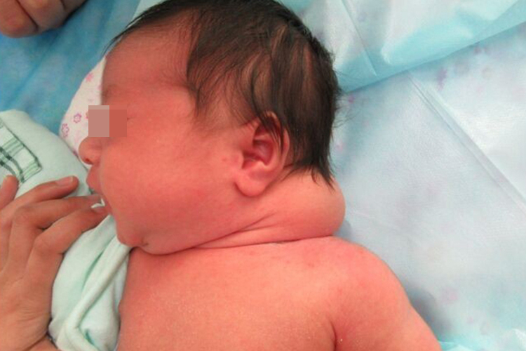 宝宝脖子静脉畸形图