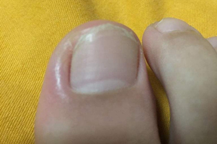 慢性甲沟炎大脚趾边上红肿图 慢性甲沟炎大脚趾边上红肿图
