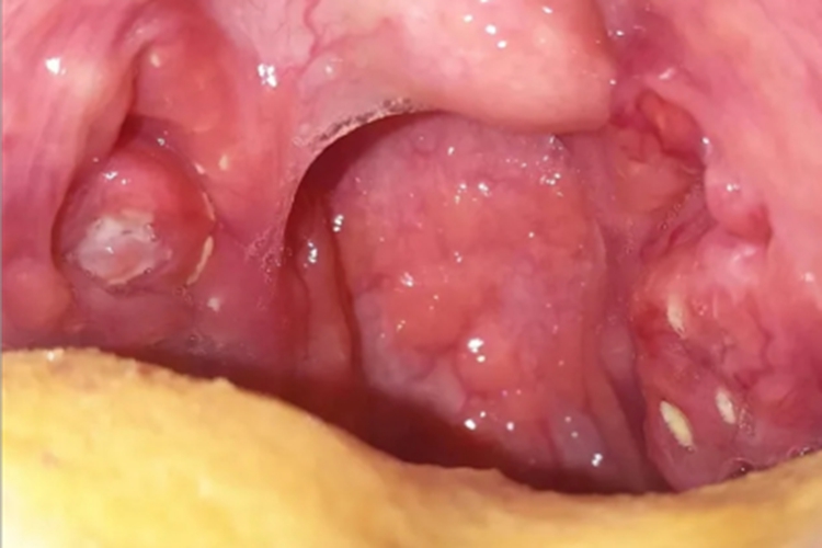 化脓性扁桃体炎扁桃体化脓图 化脓性扁桃体炎扁桃体化脓图