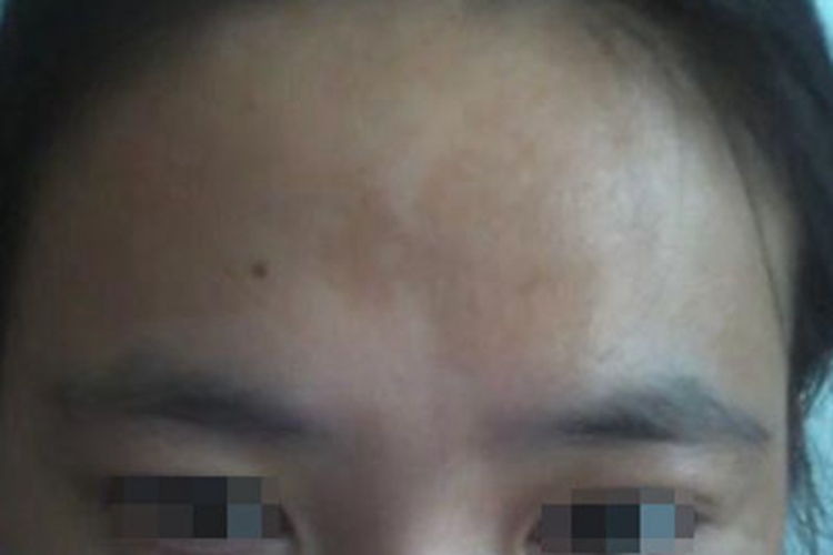 色素性化妆品皮炎前额症状图