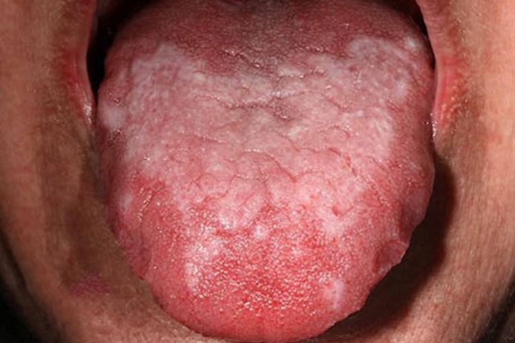 口腔扁平苔藓舌头斑块图