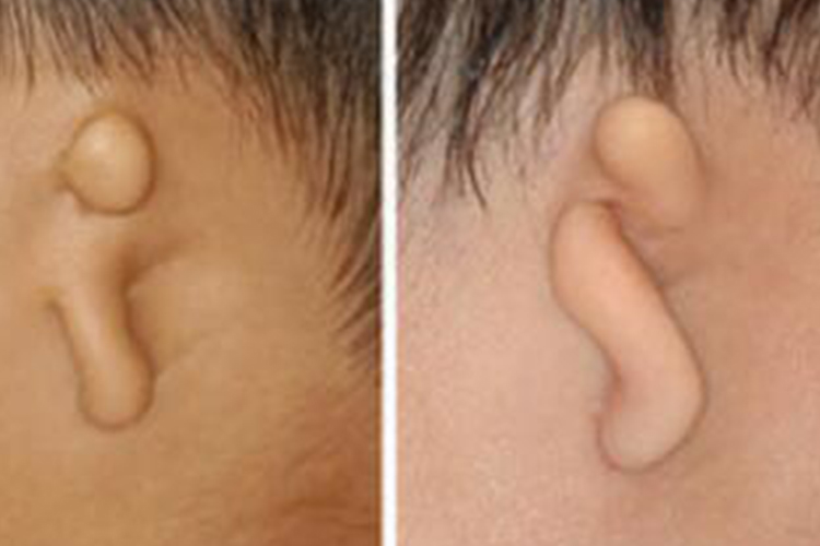 外耳畸形Ⅲ型图