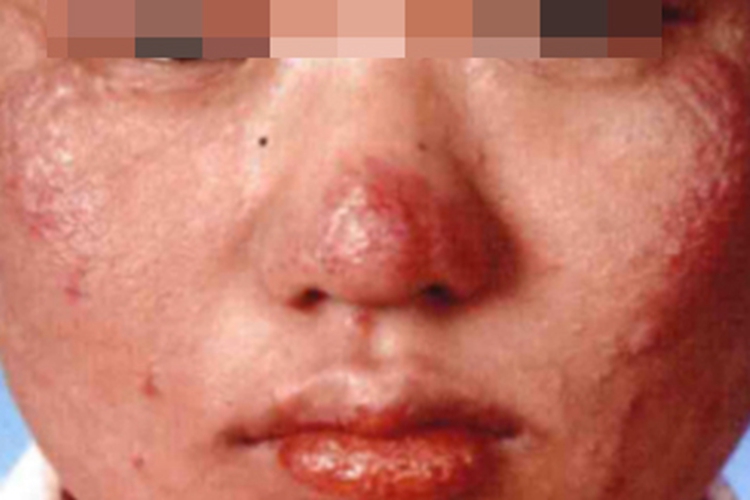 红细胞生成性原卟啉病面部丘疹图 红细胞生成性原卟啉病面部丘疹图