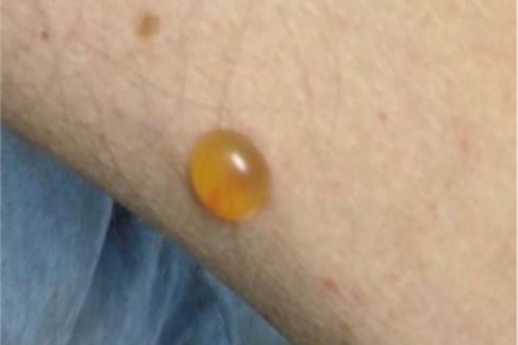 皮肤白血病水疱图 皮肤白血病水疱图