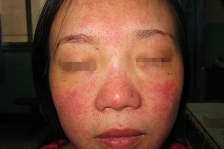 青年成人期特应性皮炎面部症状图 青年成人期特应性皮炎面部症状图