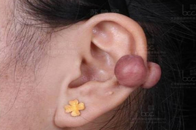 耳部瘢痕疙瘩图