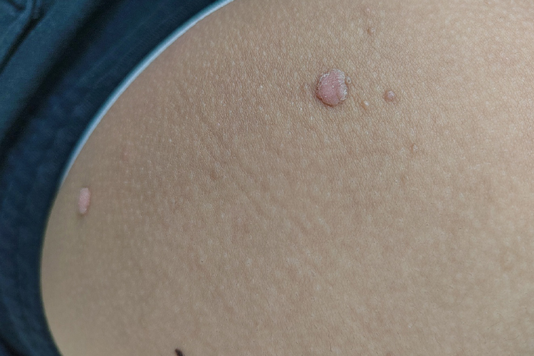 腰部寻常疣图 腰部寻常疣图