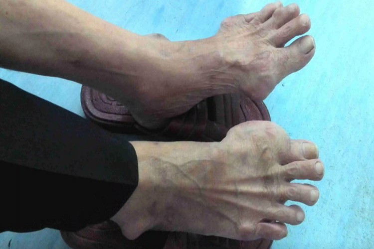 慢性痛风性关节炎期图