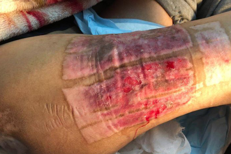 大腿取皮后图 大腿取皮后图