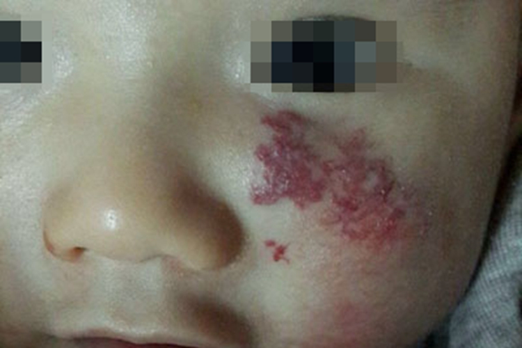 静脉畸形面部凹凸不平图
