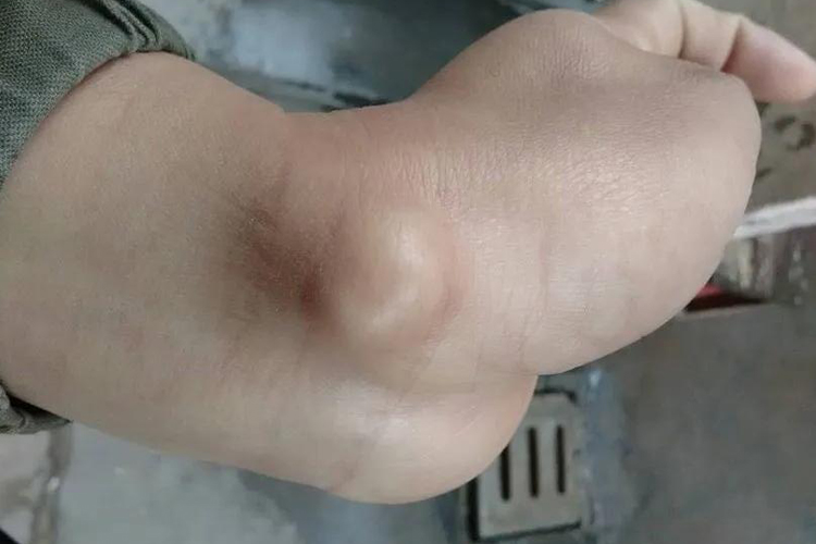 桡骨茎突狭窄性腱鞘炎图 桡骨茎突狭窄性腱鞘炎图