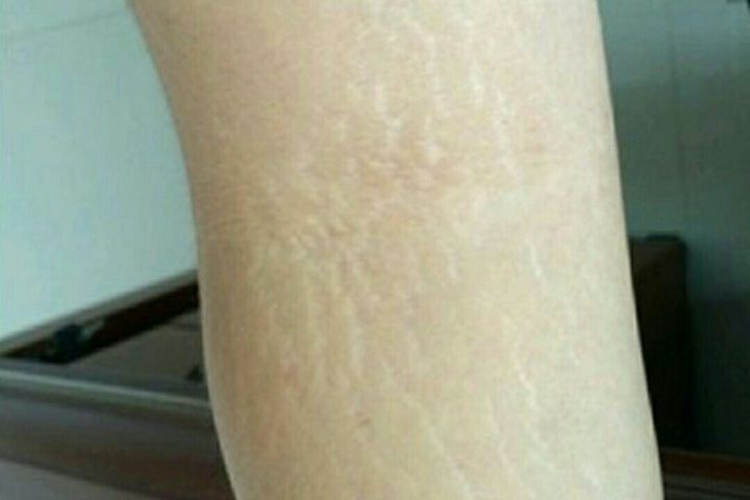 白色萎缩纹图 白色萎缩纹图