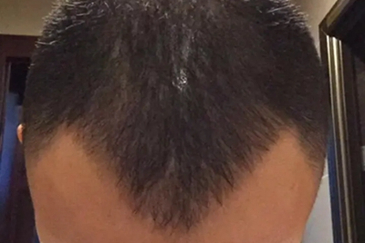 雄激素性脱发头部有M形脱发图 雄激素性脱发头部有M形脱发图