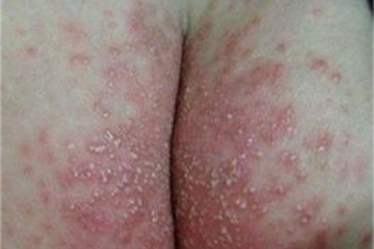 尿布皮炎大红疙瘩图