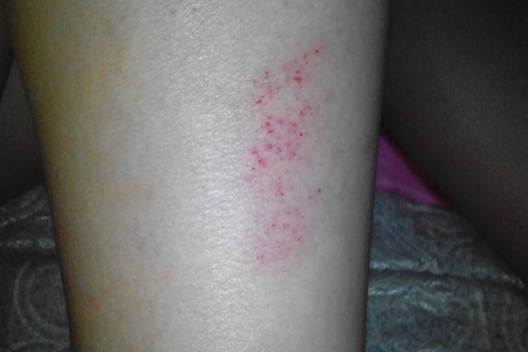 抓伤小腿血点图