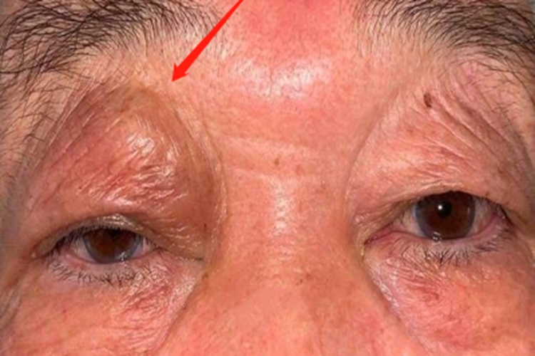 眼眶肿瘤眼周肿块图